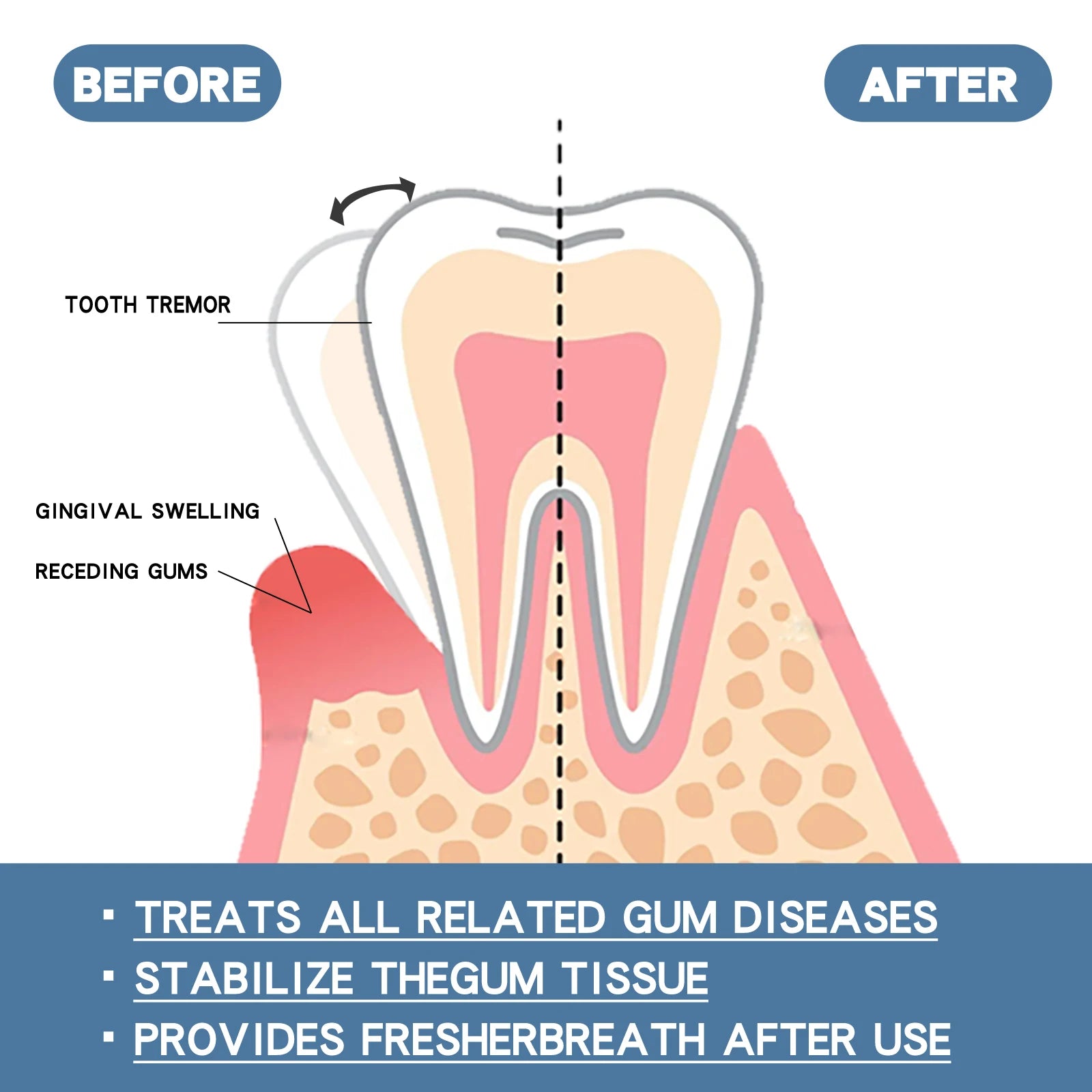 Sérum de réparation rapide des gencives, soulage efficacement l'allergie dentaire, carie dentaire, nettoyage des dents, dentifrice, soulage les gouttes de dommages dentaires
